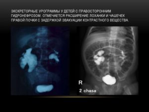 Расширение лоханки правой почки у ребенка