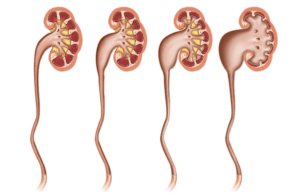 Расширение в почке лечение