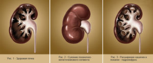 Расширение в почке лечение