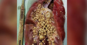 Семена льна от камней в почках