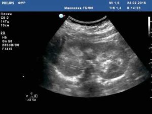 Синдром выделяющихся пирамидок