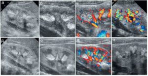 Синдром выделяющихся пирамидок