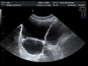 Узи при цистите и уретрите у женщин