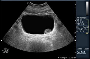 Узи при цистите и уретрите у женщин