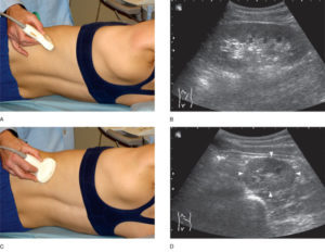 Узи почек что такое