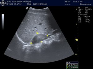 Узи в динамике почки