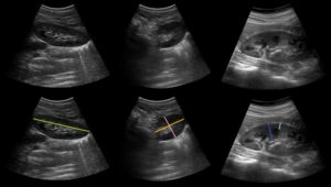 Узи в динамике почки