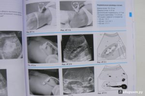 Узи гдз почек это