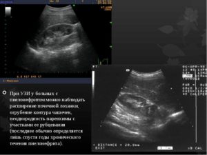 Узи гдз почек это