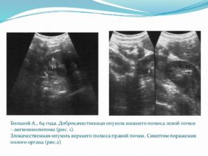 В верхнем полюсе левой почки объемное образование