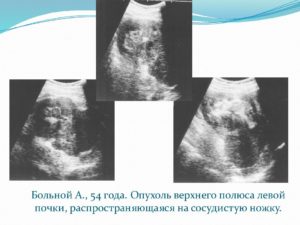 В верхнем полюсе левой почки объемное образование