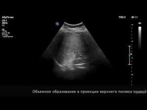 В верхнем полюсе левой почки объемное образование