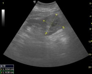 В верхнем полюсе левой почки объемное образование