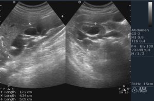 Увеличена лоханка в почке у месячного ребенка