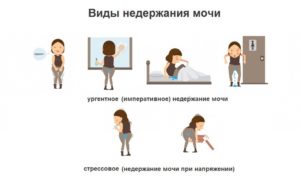Ургентное недержание мочи это