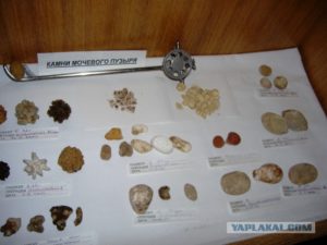 Выведение камней из почек и мочевого пузыря