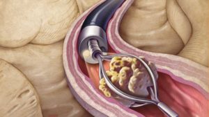 Выведение камней из почек и мочевого пузыря