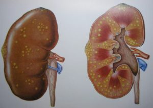 Воспаление в почках причины