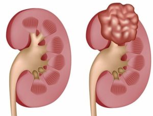 Воспаление в почках причины