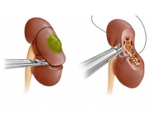 Удаление одной почки
