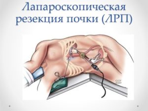 Удаление одной почки