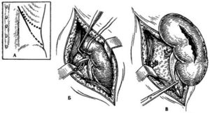 Удаление одной почки
