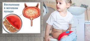 У девочки 11 лет цистит чем лечить