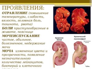 Тошнота при болях в почках