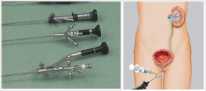 Стенд после удаления камня из мочеточника