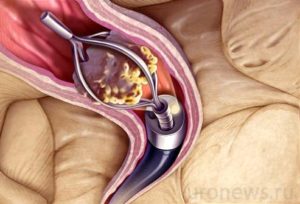 Стенд после удаления камня из мочеточника