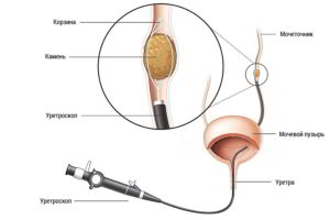 Стенд после удаления камня из мочеточника