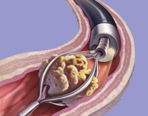 Стенд после удаления камня из мочеточника