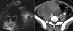 Солидно кистозное образование это рак