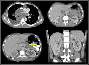 Солидно кистозное образование это рак