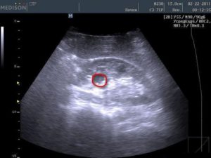 Затемнение в почке на узи