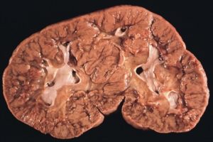 Злокачественная опухоль почек у детей