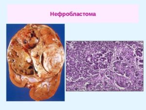 Злокачественная опухоль почек у детей